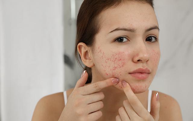 ayurveda-to-treat-acne