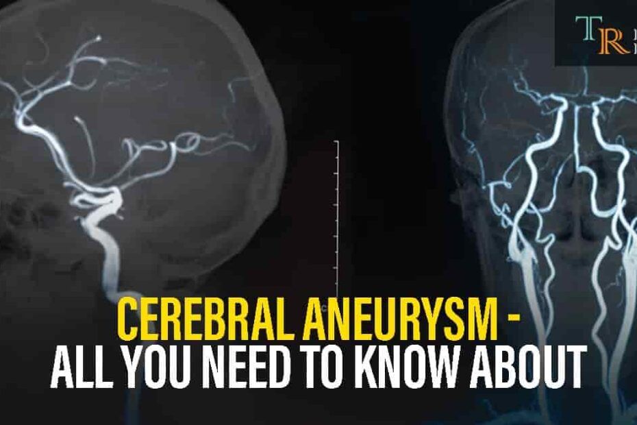 Cerebral Aneurysm Disease
