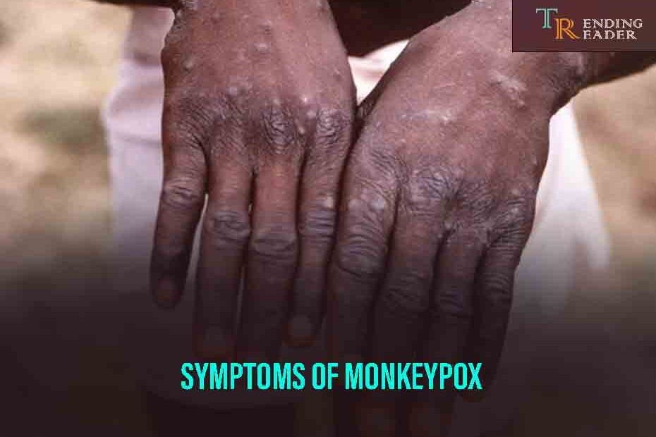 symptoms of Monkeypox