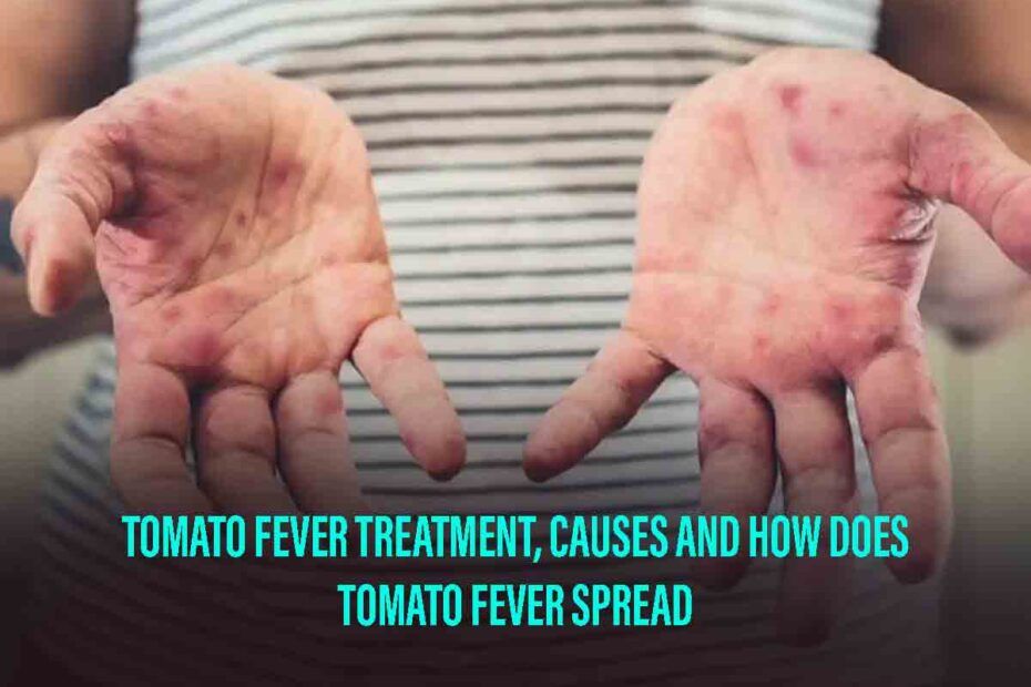 how does tomato fever spread
